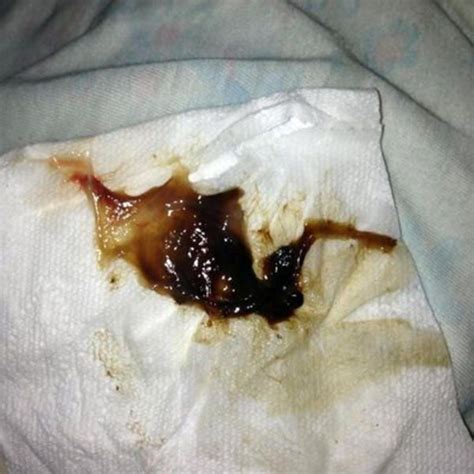 You need to contact your doctor. What a mucus plug looks like: photos | Mucus plug, Mucous ...