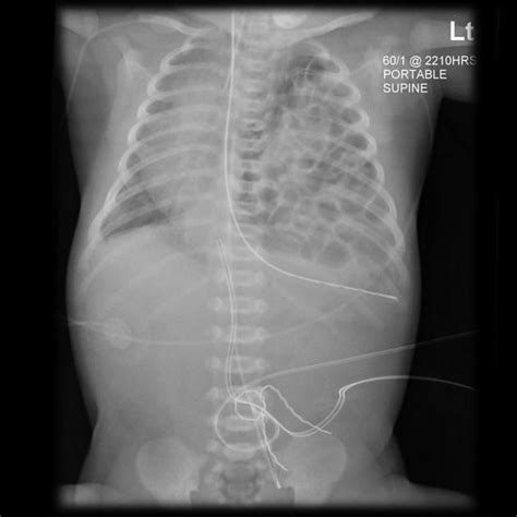 Congenital Diaphragmatic Herniation Cdh Accounts For A Small Proportion Of All Diaphragmatic