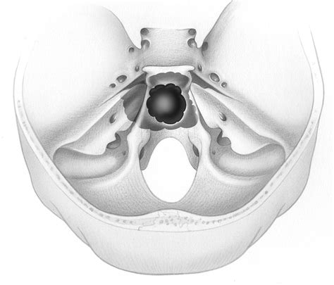 Lateral Approaches To Clivus Skull Base Surgery Atlas