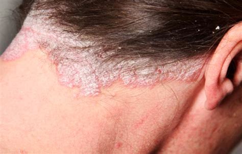 Psoriasis Treatment In York Pa Dermatology Associates Of York Inc