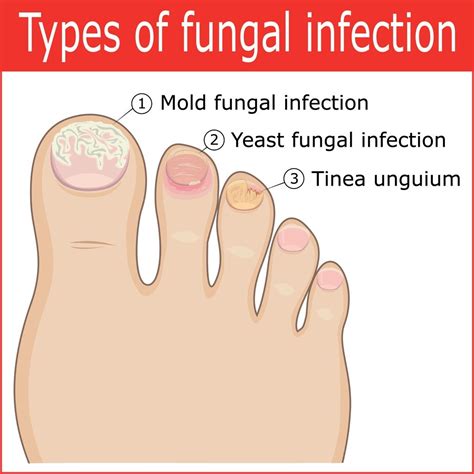 Fungal Infection Nails