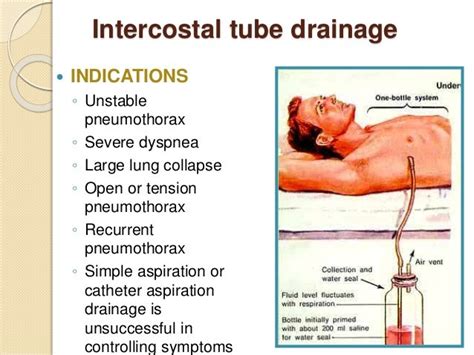 Pneumothorax