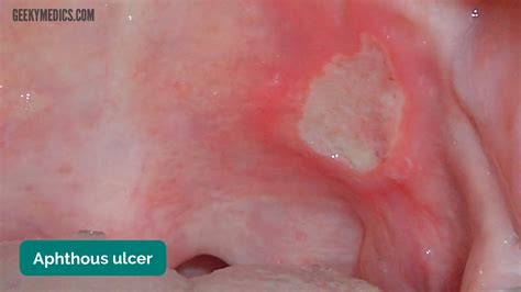 Oral Cavity Examination Osce Guide Geeky Medics