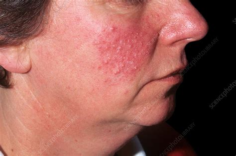 Acne Rosacea Stock Image C0372745 Science Photo Library