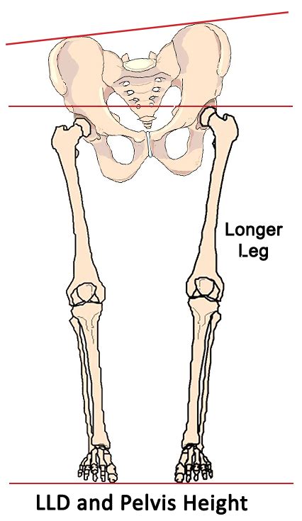 Leg Length Discrepancy Is It Causing Your Pain And Dysfunction Neta