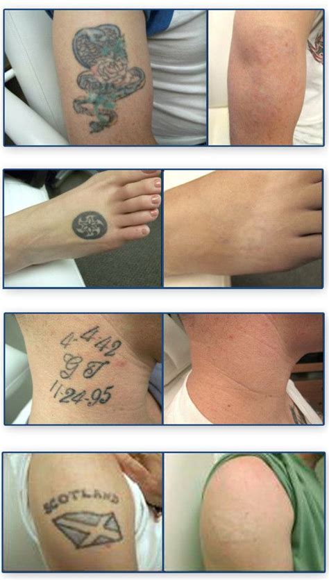 Tattoo Removal Before And After Tattoo Removal Laser Tattoo Laser Tattoo Removal
