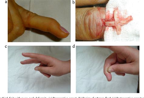 Figure 1 From A New Surgical Treatment For Mallet Finger