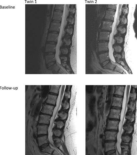 Lumbar Spine Degeneration