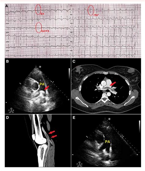 Figure 1 From High Risk Pulmonary Embolism In A Post COVID 19 Female