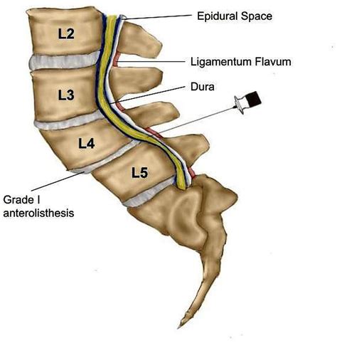 Dural Puncture During Lumbar Epidural Access In The Setting Of