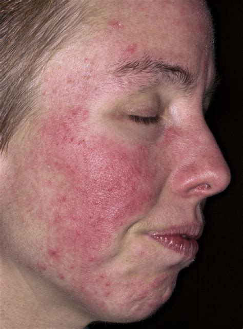 Acne Rosacea Causes Symptoms Treatment Pictures Diet Diseases