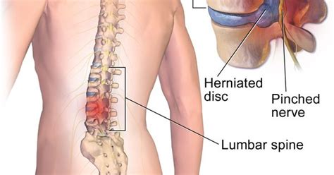 Sex With Herniated Disc Is Always A Bad Idea The Reasons Are Obvious