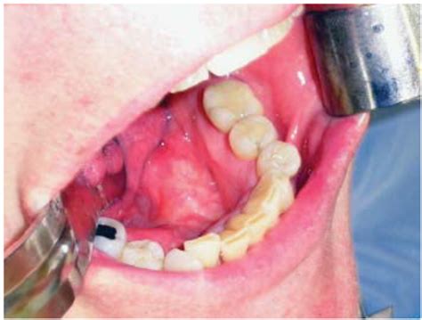 Preoperative Clinical Features Of Gin Gival Mucosa Overlying Sialolith