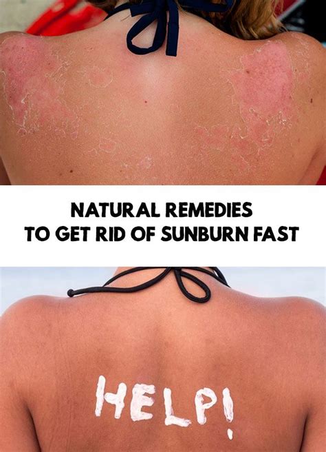 Sunburn Remedies Natural Remedies To Get Rid Of Sunburn Fast Get