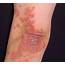 Psoriasis  Appearance Causes Types Symptoms Treatment And Diet