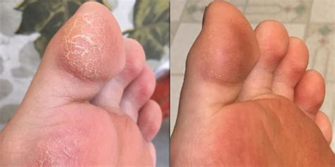 Amazon Customers Love This Foot Cream For Dry Cracked Skin