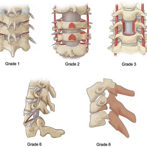 Classification Of Cervical Sagittal Balance According To The Shape Of