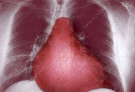 Enlarged Heart X Ray Stock Image M1720560 Science Photo Library
