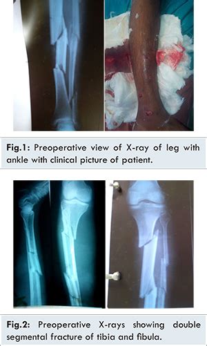Double Segmental Tibial Fracture Case Report With Review Of Literature