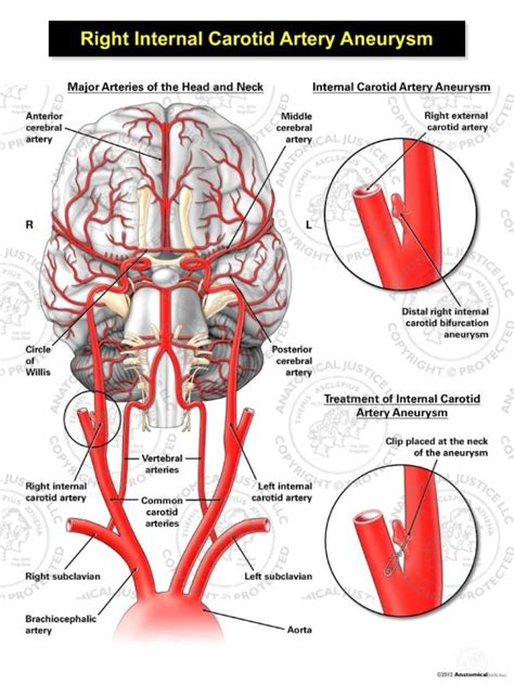 Giant Congenital Aneurysms Arteries Anatomy Internal Carotid Artery