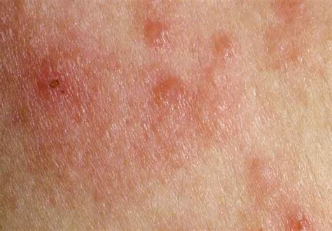 Itchy Armpit Rash Hiv Home Images And Photos Finder