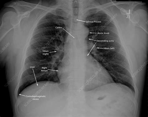 Normal Chest X Ray With Labels Stock Image C0366419 Science