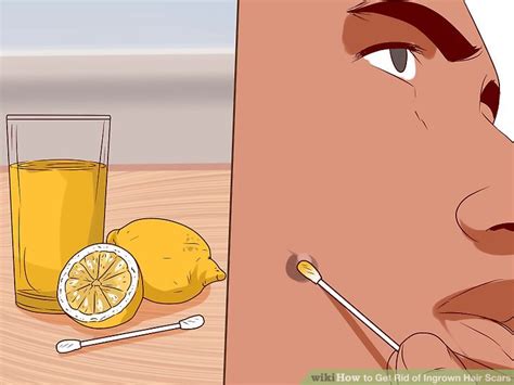 Another effective thing you can do to prevent ingrown hairs is to exfoliate. 3 Ways to Get Rid of Ingrown Hair Scars - wikiHow