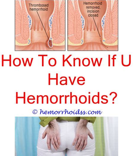 List Pictures Before And After Hemorrhoid Surgery Pictures Updated
