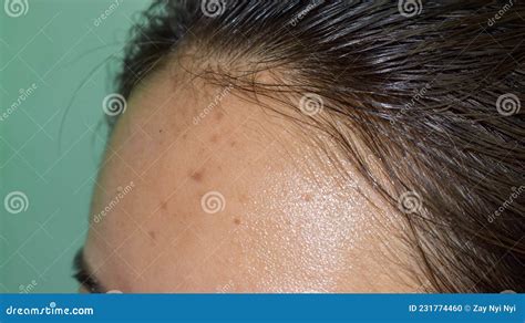 Acne Black Spots And Scars On Forehead Stock Photo Image Of Black