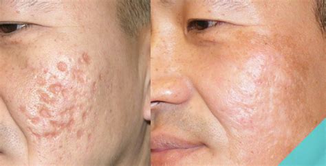 Treatments For Getting Rid Of Deep Acne Scars Spa Mdspa Md