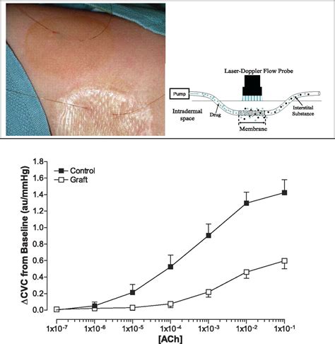 Cutaneous Vascular And Sudomotor Responses In Human Skin Grafts