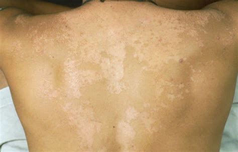 Os 8 Principais Sintomas Da Tinea Versicolor Dicas De Musculação