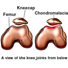 Chondromalacia Patella Pro Knee Pain Relief
