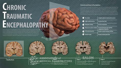 Chronic Traumatic Encephalopathy AMI Cleveland