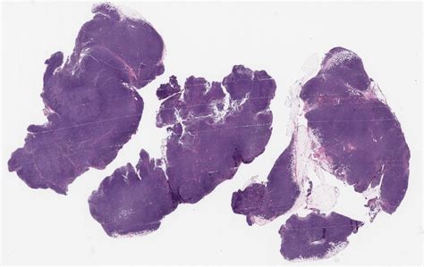 Mantle Cell Lymphoma With Classic And Pleomorphic Features By Siba El