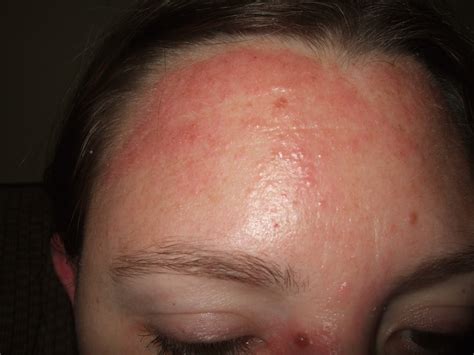 Red Rash On Face