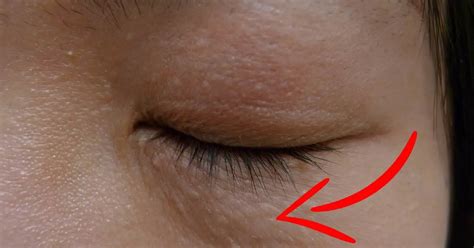How To Remove Syringomas Permanently At Home Health And Healthy Life