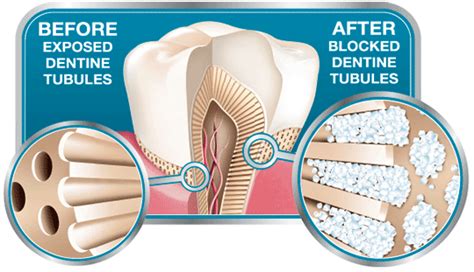 Teeth Dentine Hypersensitivity Feb 16 Skygate Dental
