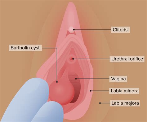 Benign Vulvar Conditions Concise Medical Knowledge