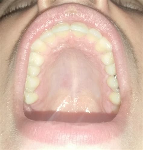 Developed A Small Bump On The Roof Of My Mouth A Little Worried About