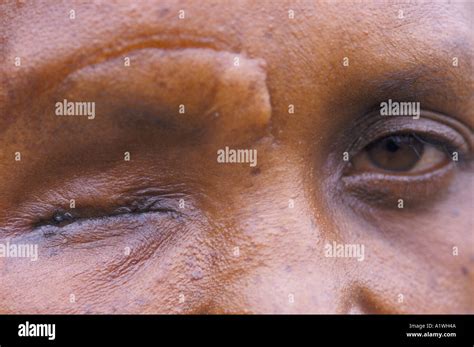 Genocide Survivor Christine Whose Eye Was Gouged Out 1994 Stock Photo