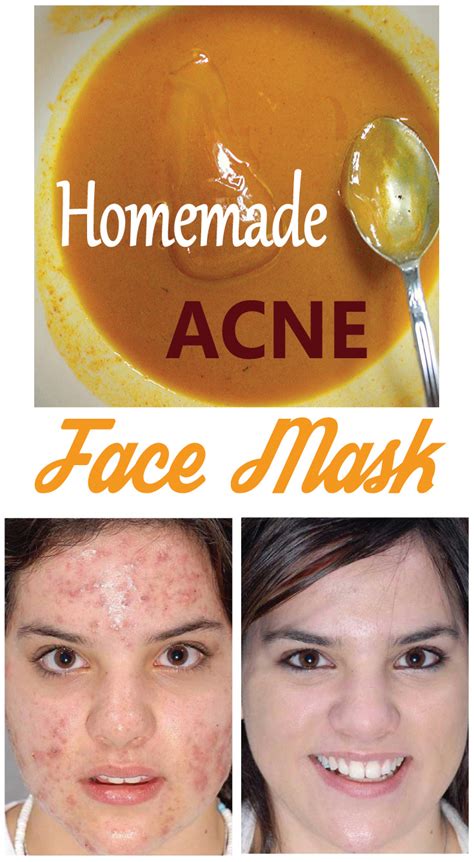 Homemade Acne Face Mask Weight Loss Lose Weight Fast With Diet Tips
