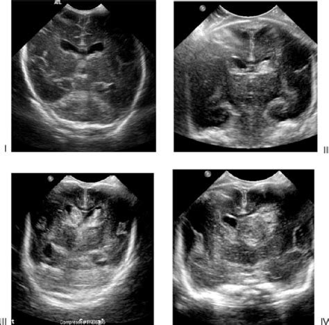 Grades Of Germinal Matrix Intraventricular Hemorrhage Grades I To Iv