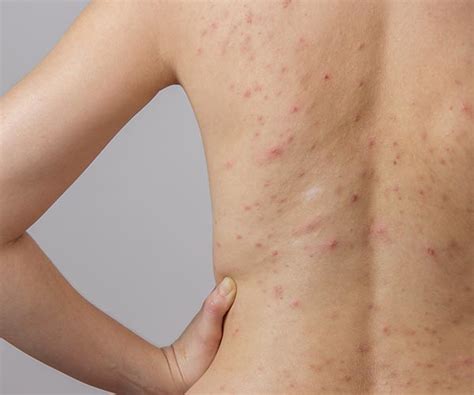 The Sneaky Reason Youre Getting Backne Back Acne Shefinds