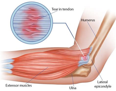 Elbow Tendonitis Treatment In Nyc New York Pain Care
