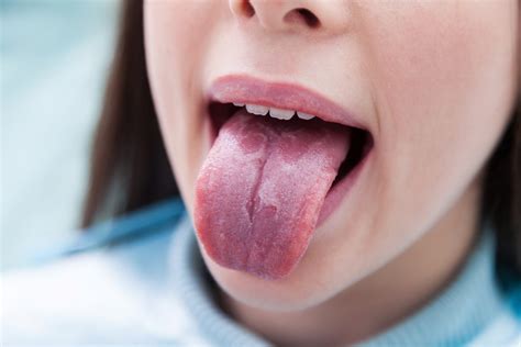 Geographic Tongue Causes Symptoms And Treatment London