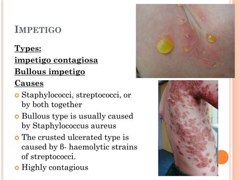 Ppt Skin Infections Powerpoint Presentation Free Download Id287256