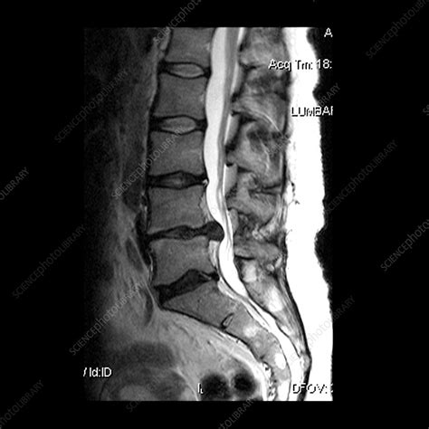 Large Lumbar Herniated Disc Stock Image M3301483 Science Photo Library