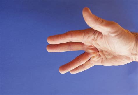 How Dupuytrens Contracture Is Treated With Rehabilitation Dupuytren