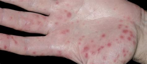 Health Department Warns Of Hand Foot And Mouth Disease Epidemic